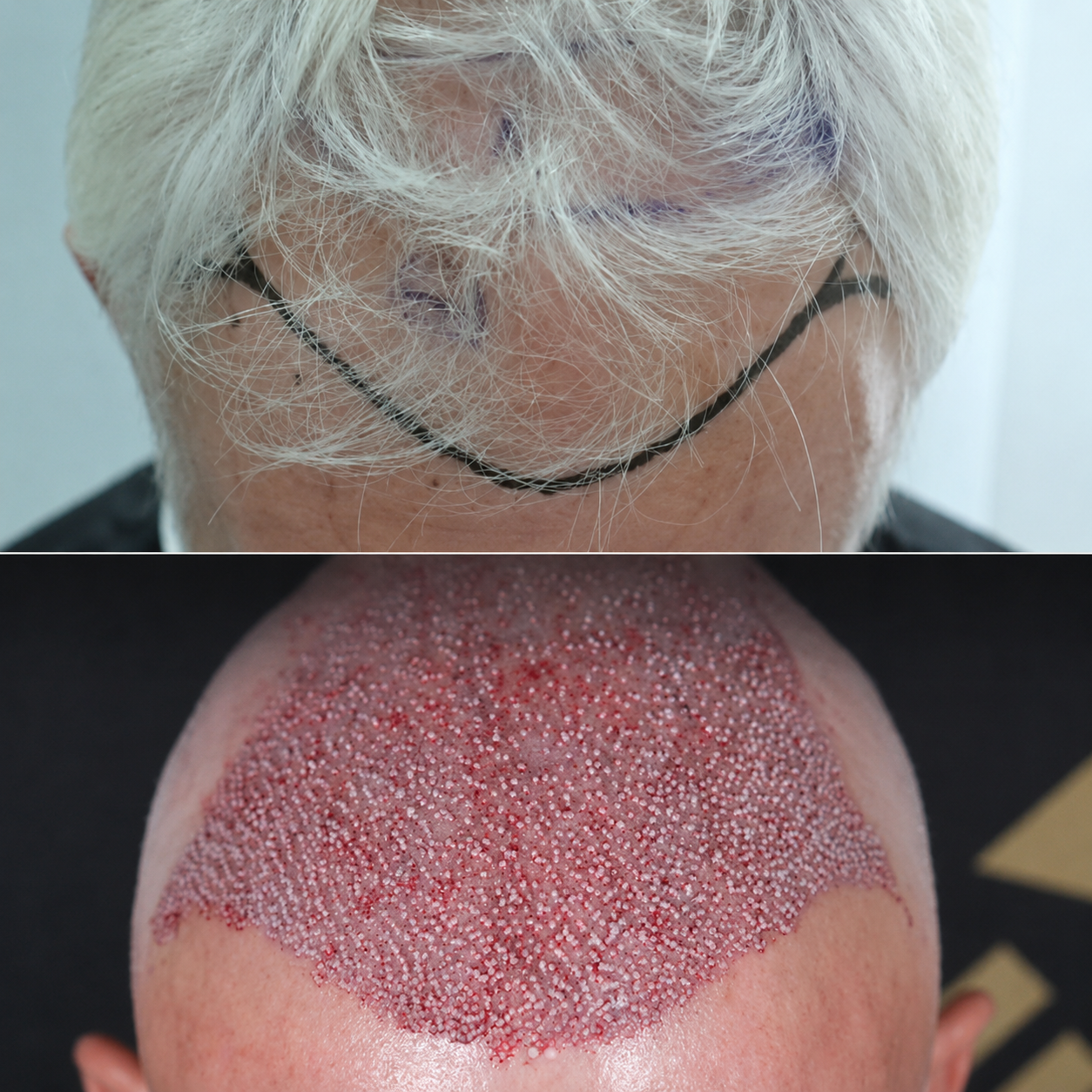 Close-up images of a person's forehead: the top image shows the person wearing glasses and sweating, and the bottom image shows the forehead with marked areas for a cosmetic procedure with small dots and a dotted pattern.
