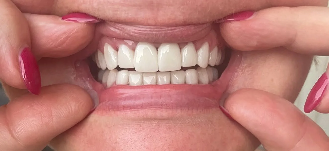 Person holding their lips open to reveal bright, white teeth with dental veneers.