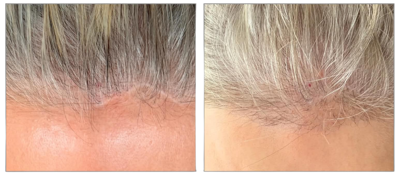 Close-up of scalp with a small red spot surrounded by grey and blonde hair.