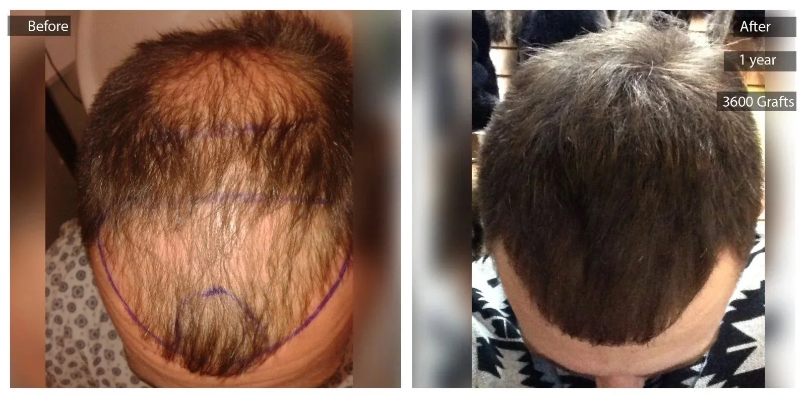 Comparison of a man's scalp showing before and after hair restoration with markings and text indicating 1 year and 3600 grafts for the after photo.